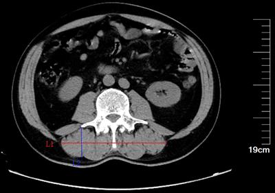 Linear Skeletal Muscle Index and Muscle Attenuation May Be New Prognostic Factors in Colorectal Carcinoma Treated by Radical Resection